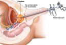 Próstata – RTU: Biopsia